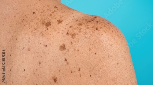 Close up of senile lentigines and dark sun spots on shoulder of elderly person with blue background