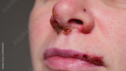 Close-up of a person's nose and lips with cold sores and skin irritation
