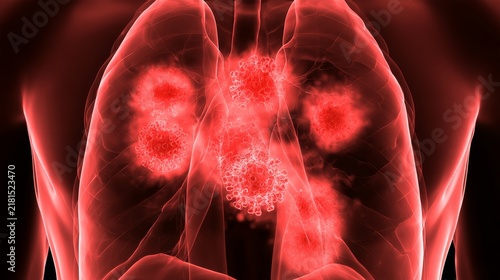 Red virus infection in human chest, medical illustration showing viral particles spreading through respiratory tissue, infectious disease concept, immune response, inflammation, healthcare, illness