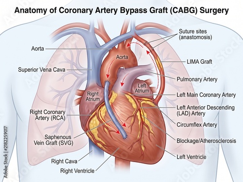 Coronary Artery Bypass Graft Surgery Anatomy Explained
