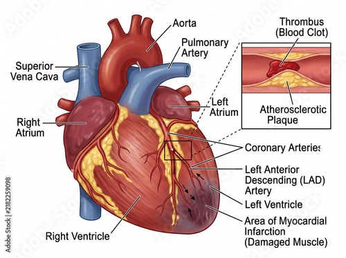 Heart Attack Coronary Artery Blockage and Damage