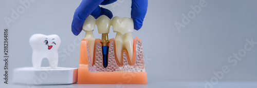 Foto Dentist holding bridge on implant model