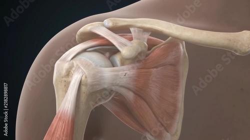 3D Medical Animation Showing Rotator Cuff Injury in the Shoulder