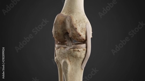 3D Medical Animation Showing Knee Osteoarthritis and Osteophytes