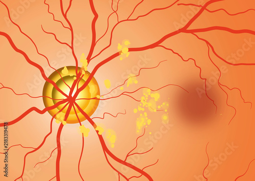 Dry macular degeneration, illustration