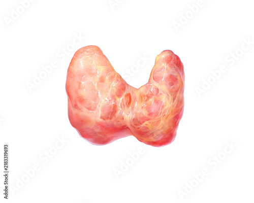 Overactive enlarged thyroid, illustration