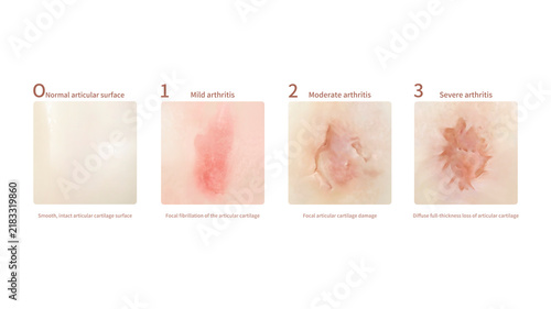 Osteoarthritis local integration, illustration