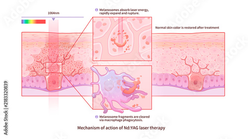 Nd-YAG laser treatment mechanism, illustration