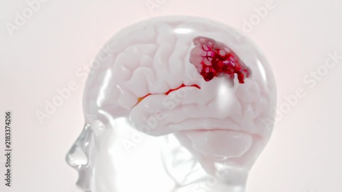 Brain damage or cancer tumor malignant cells growth and spreading. Can be used in medical elements related meningioma or neurological disease, 3D Render.
