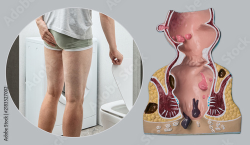 Fotografie Medical collage combining a man holding his buttocks in pain by the toilet with an anatomical model of rectal hemorrhoids during a comprehensive gastroenterology consultation