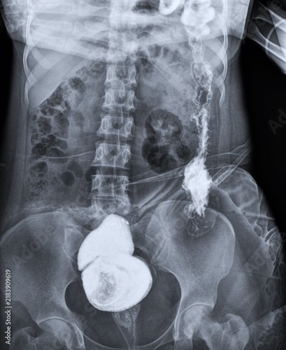 Fotografie Barium Swallow Fluoroscopy X-Ray Showing Contrast Filling Left Colon and Rectum