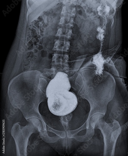 Canvas Print Abdominal Contrast Radiograph Demonstrating Lower Gastrointestinal Barium Study
