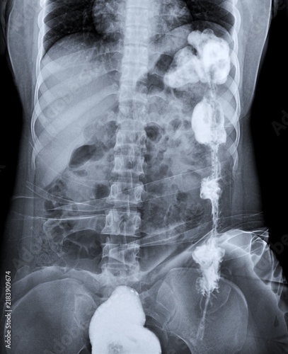 Quadro su tela Abdominothoracic Barium Enema Fluoroscopy X-Ray Highlighting Intestinal Contrast