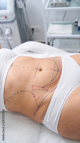 Close up of woman abdomen with surgical markings for cosmetic procedure, lying on medical bed in clinic. Plastic surgery, liposuction, aesthetic medicine.