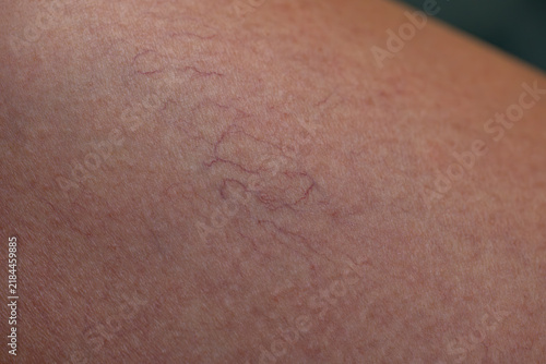 Konstfotografi spider veins on human skin macro close-up, telangiectasia capillaries mesh on le