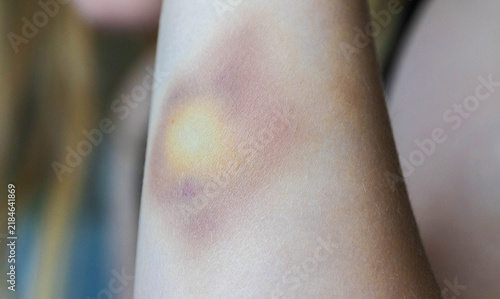 Obraz na plátne Close-up view of a healing bruise on skin of child arm, showing multiple stages of discoloration with yellow, purple, and reddish tones, indicating a recent injury and recovery process