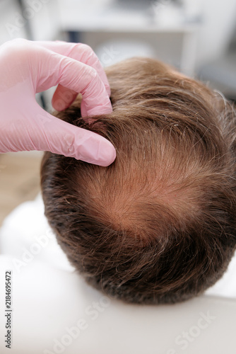 Fotografie Closeup crown scalp inspection by clinician wearing gloves at hair clinic for ma