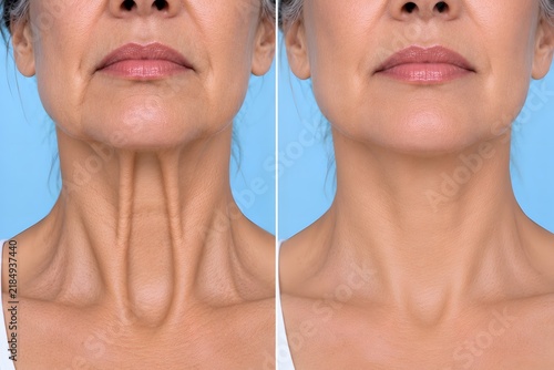 Non-invasive neck rejuvenation before and after cosmetic muscle relaxant injections on mature skin