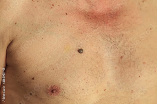 Foto Shaved chest shows skin with red marks and small bumps