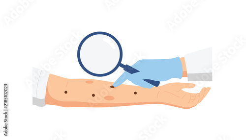 Professional dermatologist using a magnifying glass to inspect dark moles on a patient's arm for skin cancer screening.