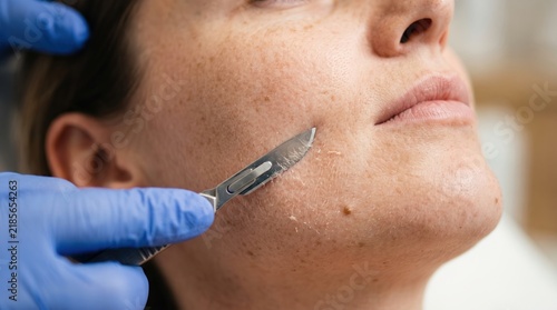 Close up of dermaplaning facial treatment scraping dead skin and vellus hair with scalpel