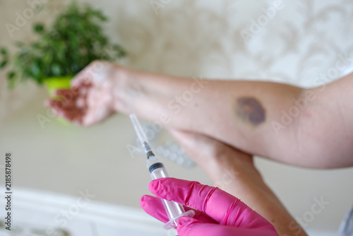 Bild auf Leinwand Bruise on arm after unsuccessful blood draw, hematoma from venipuncture with glo