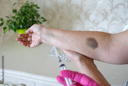 Fotografie Bruise on arm after unsuccessful blood draw, hematoma from venipuncture with glo