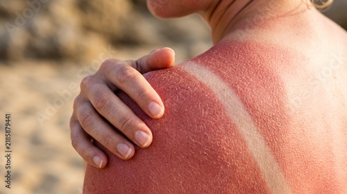 Red painful sunburned skin on female shoulder showing a clear tan line from ultraviolet ray exposure during a bright sunny summer day at the beach