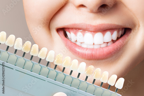 Healthy White Smile with Tooth Color Matching Guide