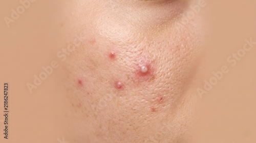 Close-up view of facial skin showing blemishes and acne
