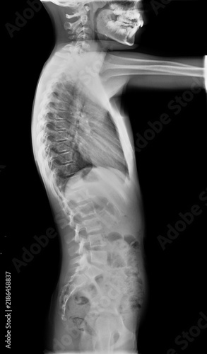Scoliosis film x-ray show spinal bend in teenager patient