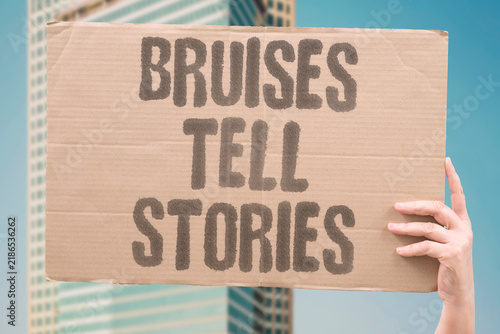 Bild auf Leinwand "Bruises tell stories" Unexplained bleeding marks on skin can signal clotting problems