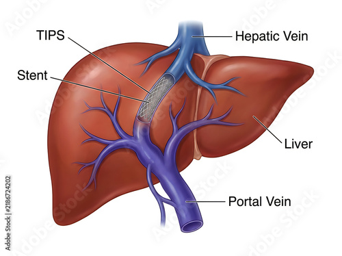 Transjugular Intrahepatic Portosystemic Shunt TIPS Procedure Medical Illustration with Liver Anatomy Diagram Isolated