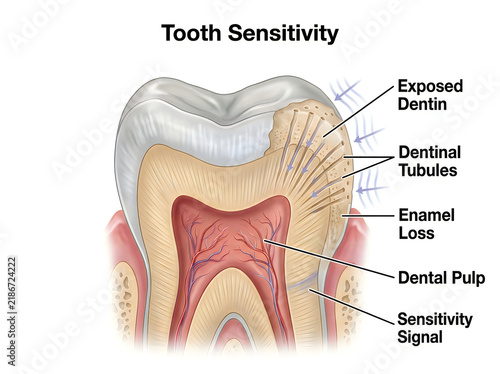 Tooth Sensitivity and Dentin Hypersensitivity Cross Section Medical Illustration Showing Enamel Loss and Dentinal Tubules Diagram Isolated