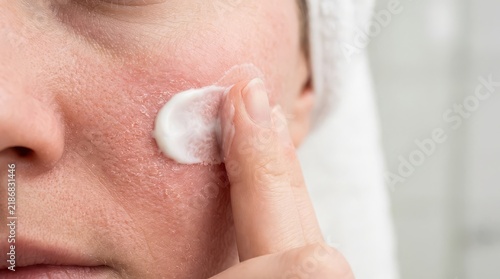 Woman applying moisturizing cream to her dry and irritated facial skin