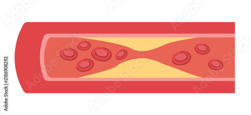 Konstfotografi Atherosclerosis in Blood Vessel