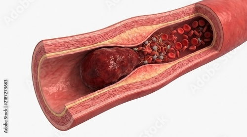 Artery section showing a blood clot causing a blockage in circulation with vascular disease blood flow circulatory system