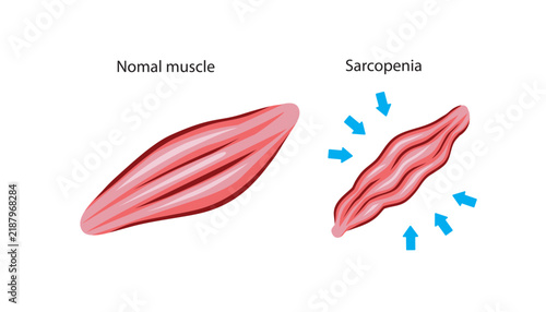 Bild auf Leinwand Muscle Contraction Medical Illustration
