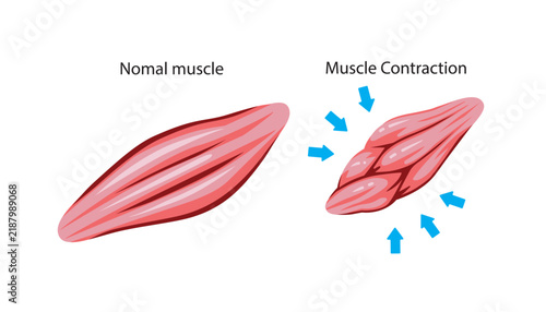 Shrunken muscle with surrounding arrows representing sarcopenia, reduced muscle mass, weakness, and age-related wasting.