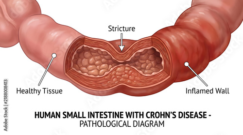 Medical illustration of human small intestine affected by Crohn's disease