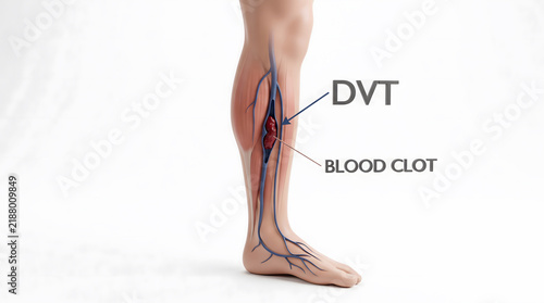 Medical illustration of deep vein thrombosis and a blood clot in leg