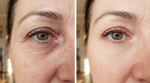 Before and After Skin Rejuvenation: Eye Area Wrinkles Treatment Comparison