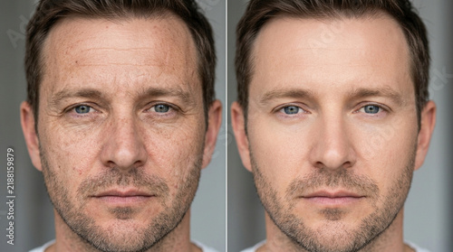 Aging Skin Comparison: Before and After Anti-Aging Treatment