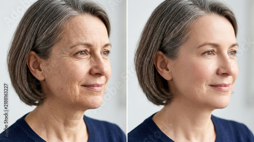 Before and After: Anti-aging cosmetic treatment, woman's skin rejuvenation