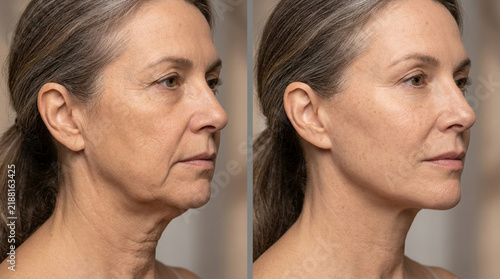 Before and After Aging Skin Treatment - Woman's Profile Comparison