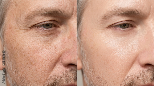 Before and After Anti-Aging Skincare: Man's Face Transformation