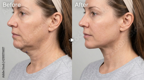 Before and After Face Aging Correction - Profile View