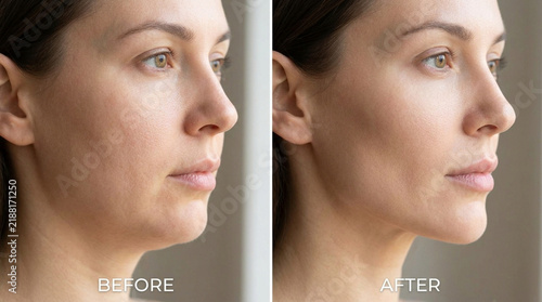 Before and After Face Slimming Treatment - Woman Profile