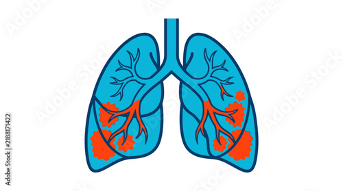 Illustration of Human Lungs Showing Respiratory Disease or Infection