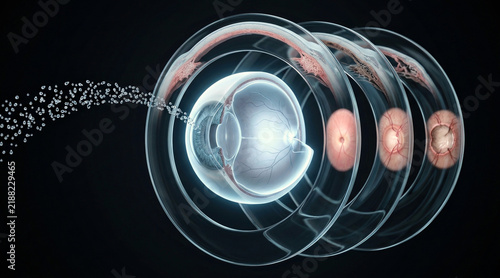 Floating eye anatomy with layered glass rings and eyedrop droplets, showing progressive glaucoma changes and optic disc cupping over time.